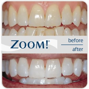 mejor dentista en miami, carillas de porcelana en miami, Botox miami, costo del tratamiento de conducto en miami, elevación de seno nasal en miami, mejores carillas en miami, mejor dentista del sur de florida, mejor dentista cosmético en miami, mejor atención dental en miami, sage dental