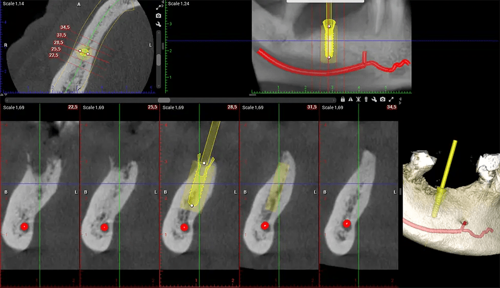 Planmeca CBCT Low Radiation G7 Implant Planning